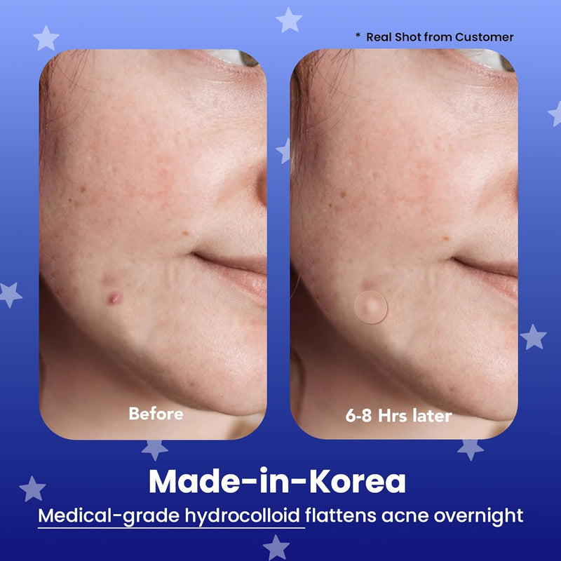 Avarelle Spot Pimple Patches for Face