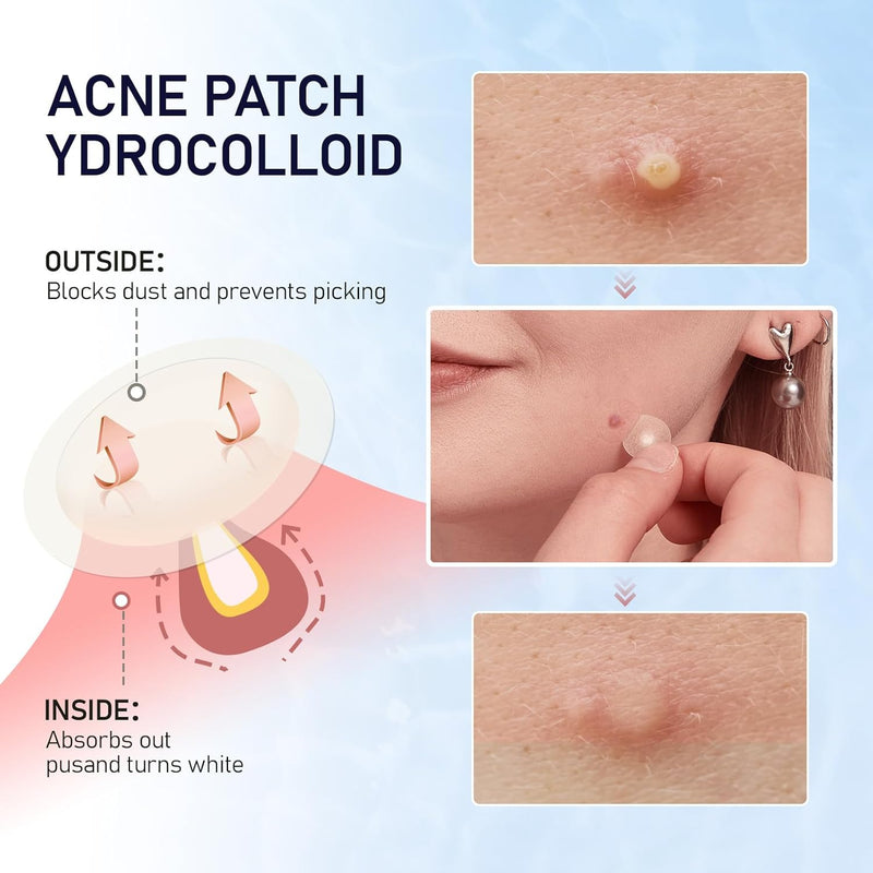 Angtics acne  patches for face