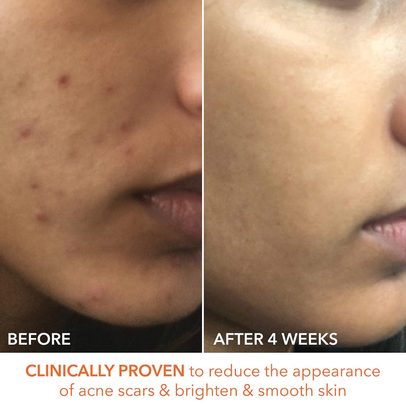 Dr. Dennis Gross Alpha Beta Extra Strength Daily Peel